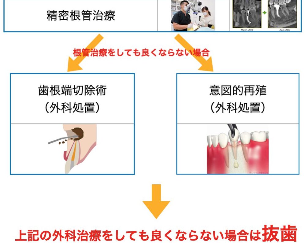 残根抜歯の手順と術後ケアのポイント